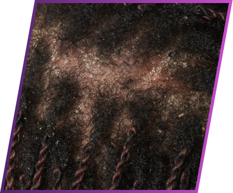 Image of flakes symptom